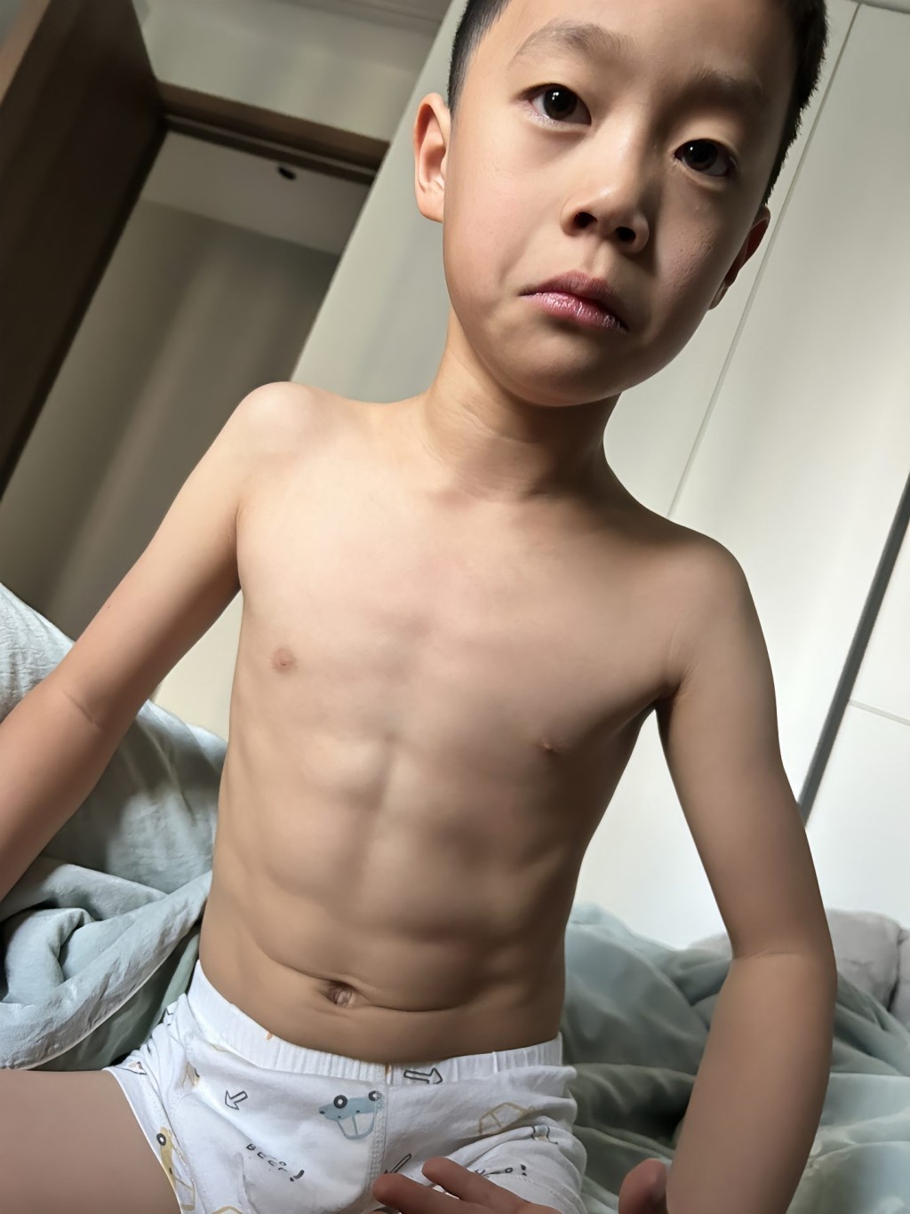 西安有7歲男童感冒咳嗽10日後，腹部出現明顯腹肌。