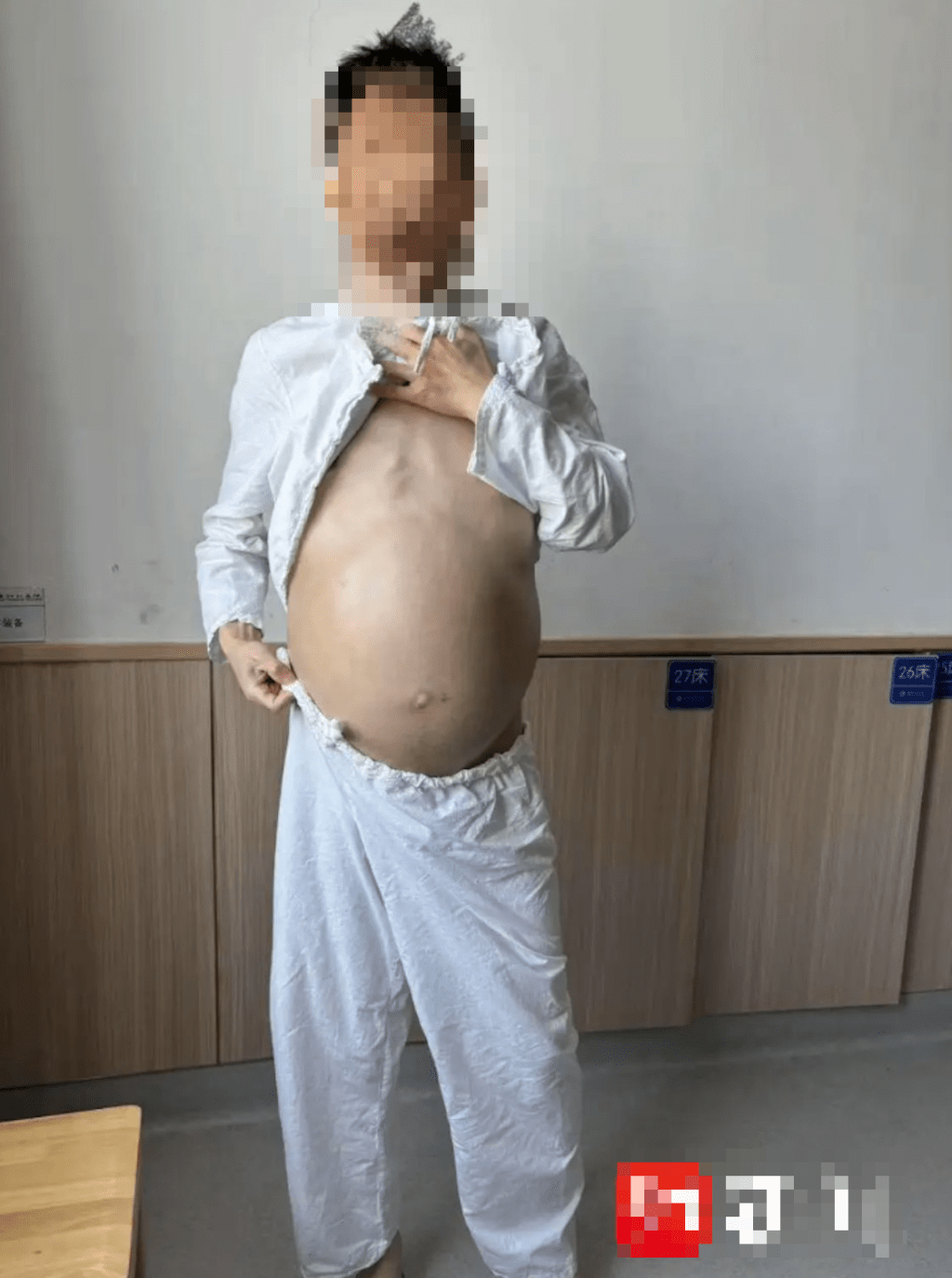 患者腹部嚴重膨隆,如十月懷胎孕婦。 患者腹部嚴重膨隆,如十月懷胎孕婦。