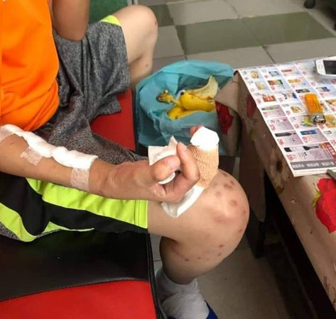 少年甚至被凌虐至手指需要截肢。(網圖)