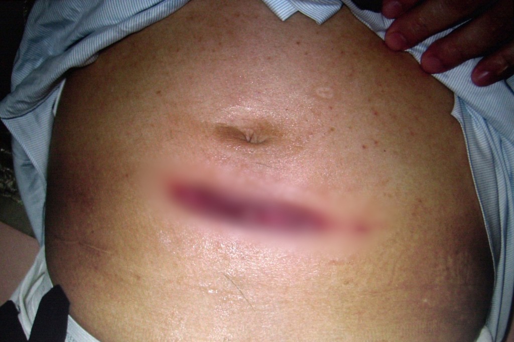 奇美醫院發布照片﹐顯示陳水扁肚臍對落腹部中央受傷。 美聯社