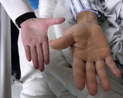 56歲男手掌變大兩倍。（網圖）