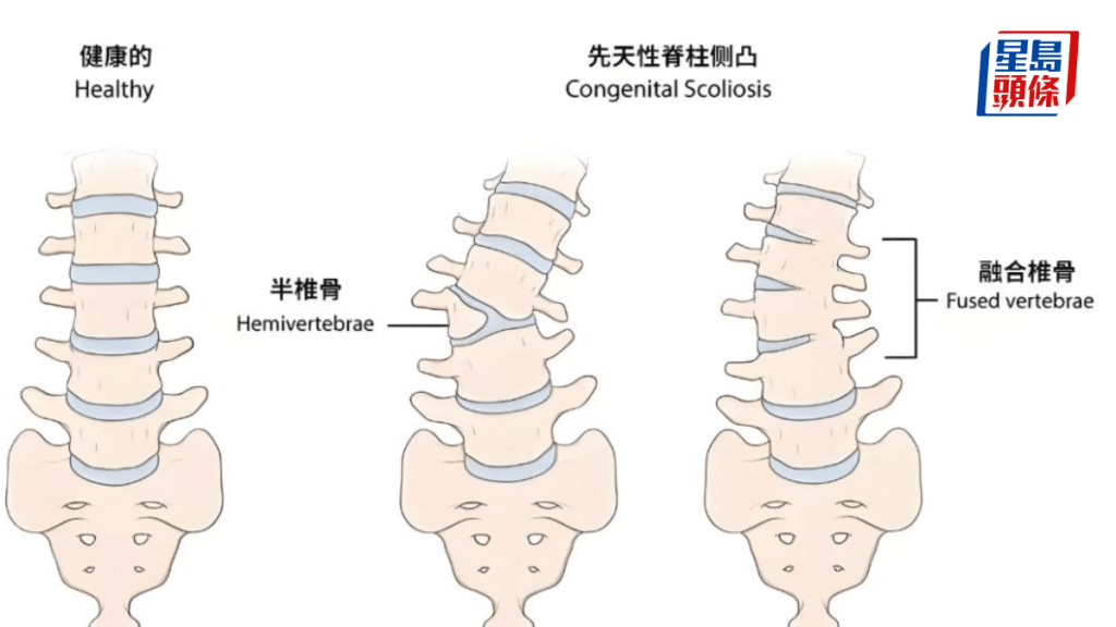 先天性脊柱側月凸。圖片由筆者提供