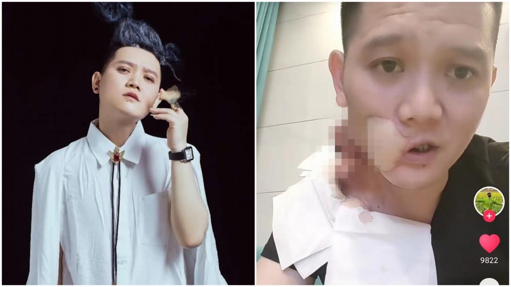 36歲《少年包青天》男星因一習慣患口腔癌 切除左臉仍不敵癌症離世