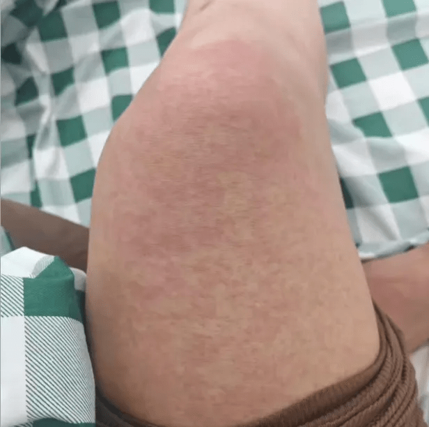 順德網友指中了基孔肯雅熱，全身大片紅疹十分十分癢。