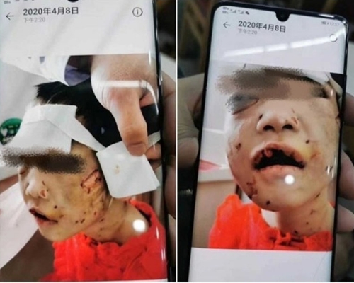 黑龍江4歲受虐女童獲6萬元司法救助。(網圖)