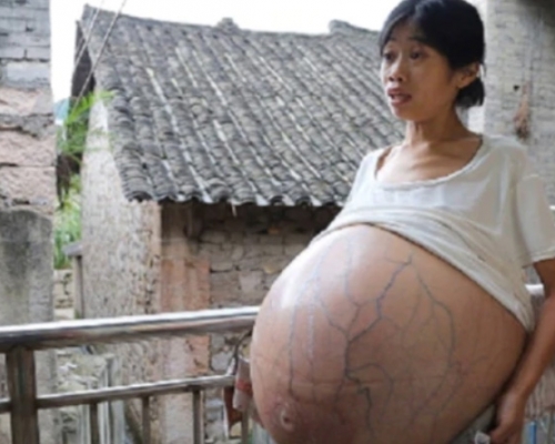 黃國嫻的腹部脹起變巨球,感嘆每晚僅能坐著在床上睡覺。 微博圖