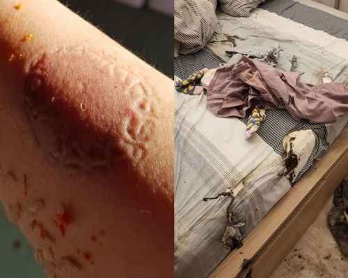 台前空姐曾被奶奶狠咬手，今與老公口角家縱火。(左:爆料公社FB圖片；右網圖)