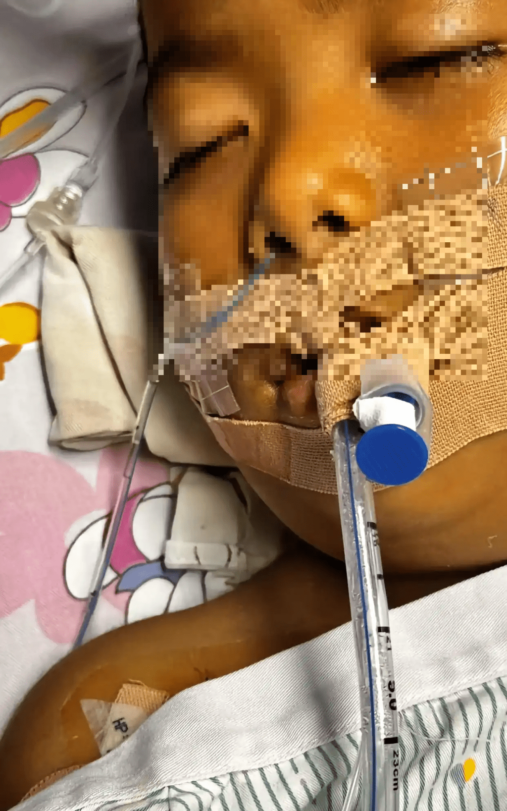  廣東3歲男童切扁桃腺術後腦死亡，意識微弱已昏迷半個月。