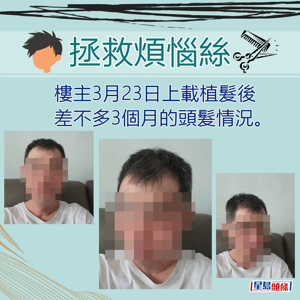樓主3月23日上載植髮後差不多3個月的頭髮情況。「香港討論區」截圖