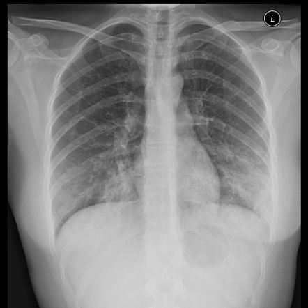 患者肺部感染情況。網上圖片