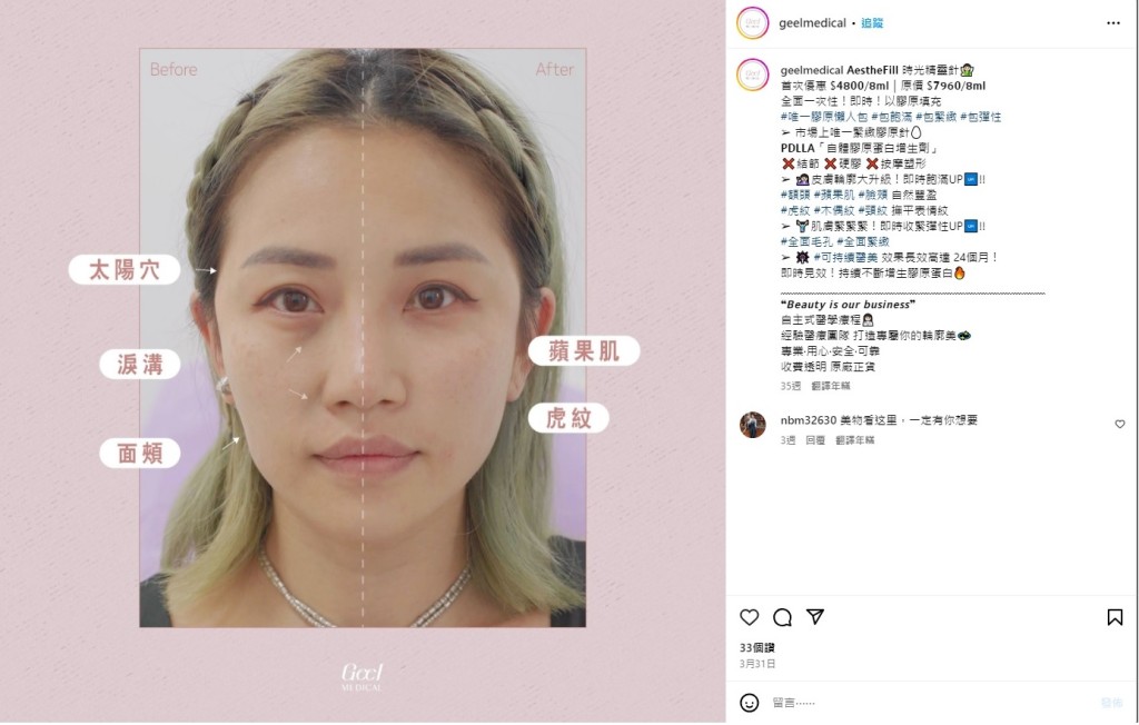 「GEEL MEDICAL 」社交專頁仍有宣傳「膠原蛋白美容針」等療程。geelmedical instagram截圖