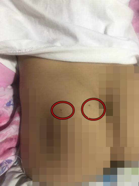 4歲女童程程身上有針孔。網圖