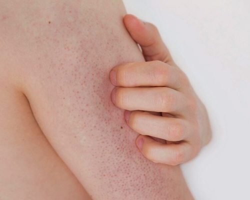 皮膚起「粒粒」可能是毛孔角化。