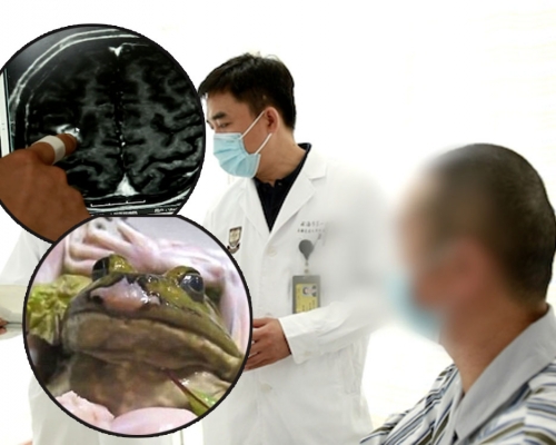 上海男欲治病輕信偏方生吃青蛙，致寄生蟲入腦。