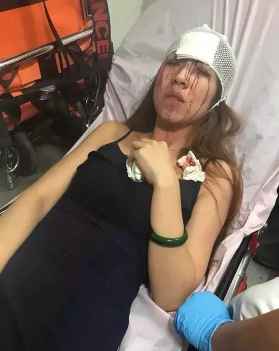 女模頭部撞擊前擋風玻璃額頭有多處創口。網圖