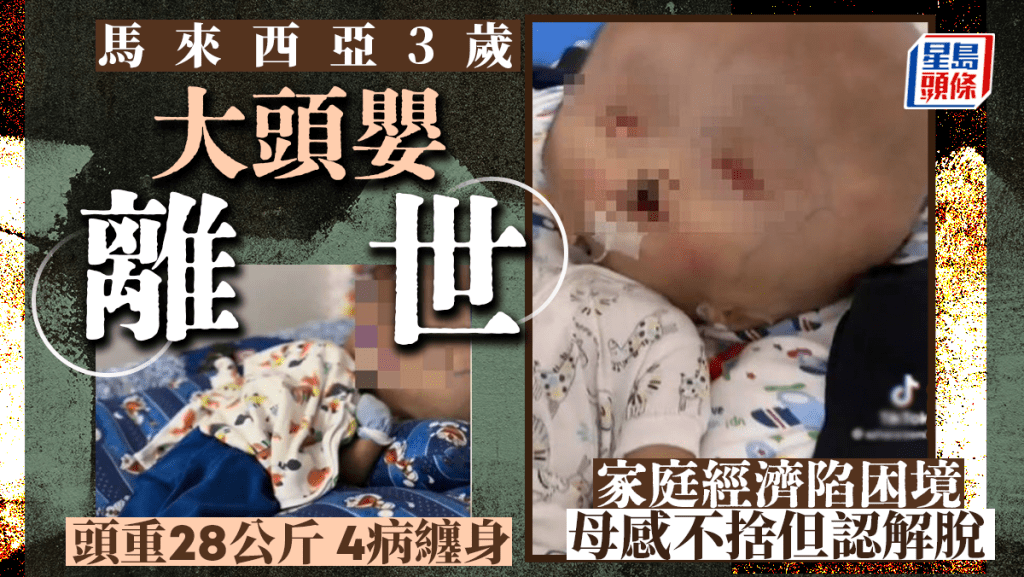 馬來西亞3歲男嬰莫哈末比拉患上無葉前腦無裂畸形症(Alobar Holoprosencephaly),頭部重達28公斤。