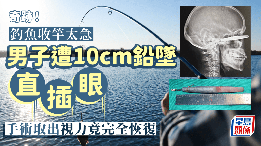 釣魚男收竿太急10cm鉛墜直插眼眶 手術取出視力竟完全恢復