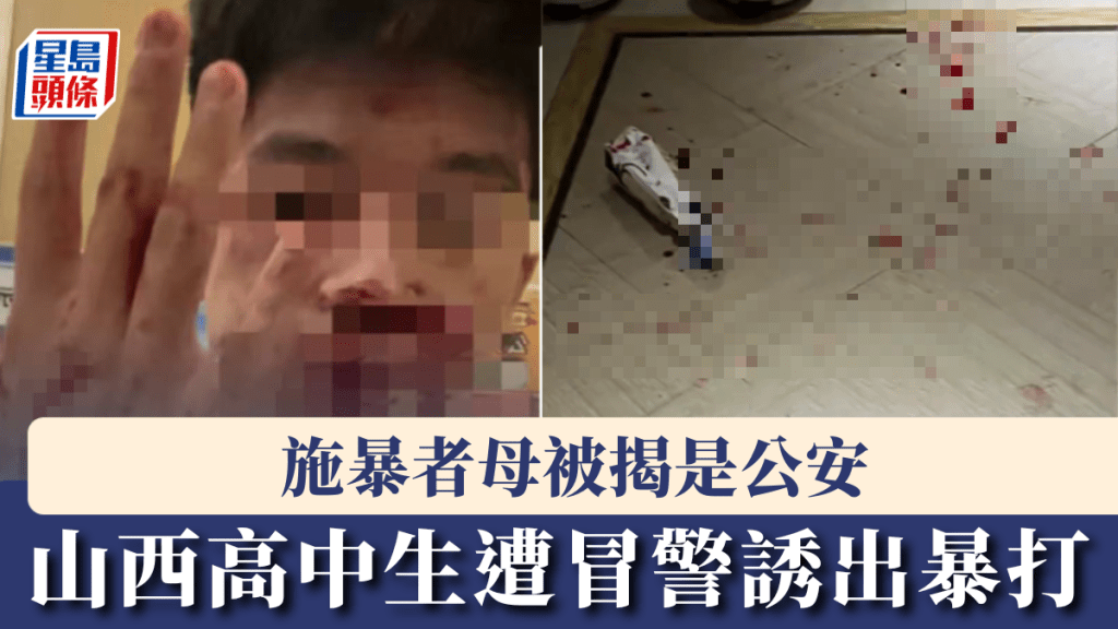 遭舊同學聯同冒警誘出暴打的山西高中生展示傷勢。