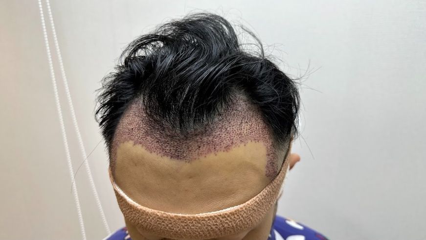 手術要將Aaron後腦1800毛囊移植到額前。