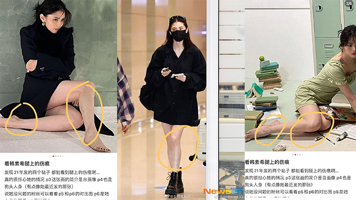 网民翻睇韩韶禧近年的照片，指她身上有不少疑似瘀伤。