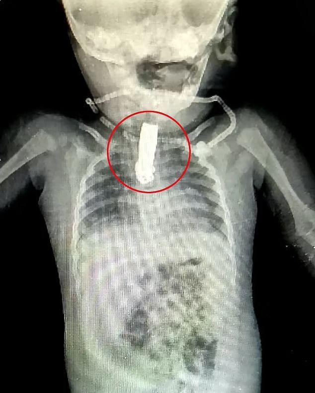 經過X光片照檢查，發現指甲鉗卡在男嬰喉嚨約15cm深處。