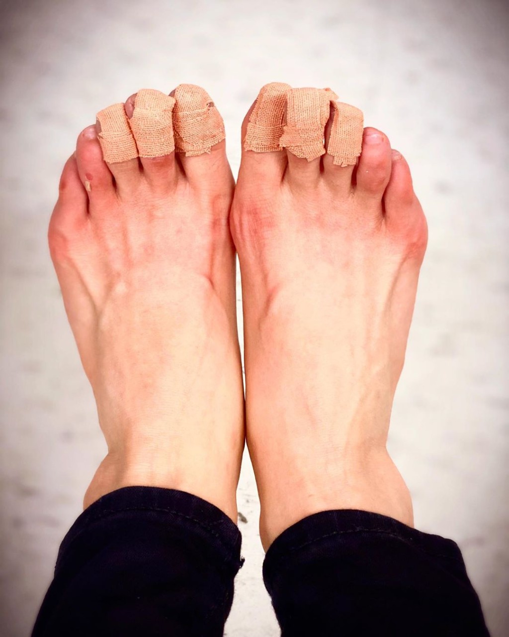 拍攝完跳舞戲，Candice雙腳即變得又紅又腫。