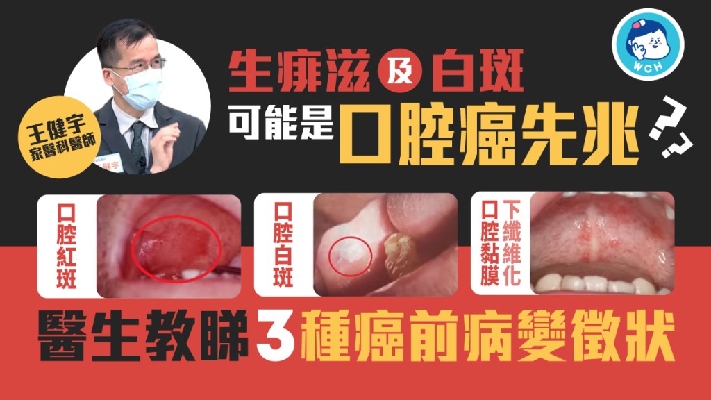 生痱滋及白斑可能是口腔癌先兆？