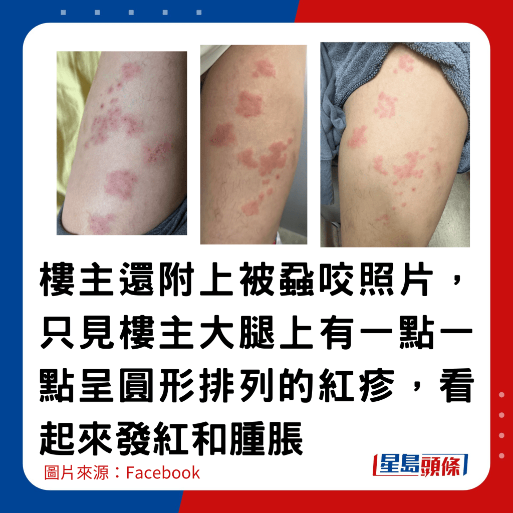 楼主还附上被虱咬照片，只见楼主大腿上有一点一点呈圆形排列的红疹，看起来发红和肿胀