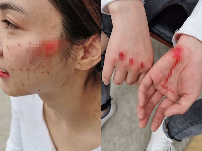 女警捉拿疑犯被拖拽數米倒地,臉部、手部多處負傷。 網上圖片