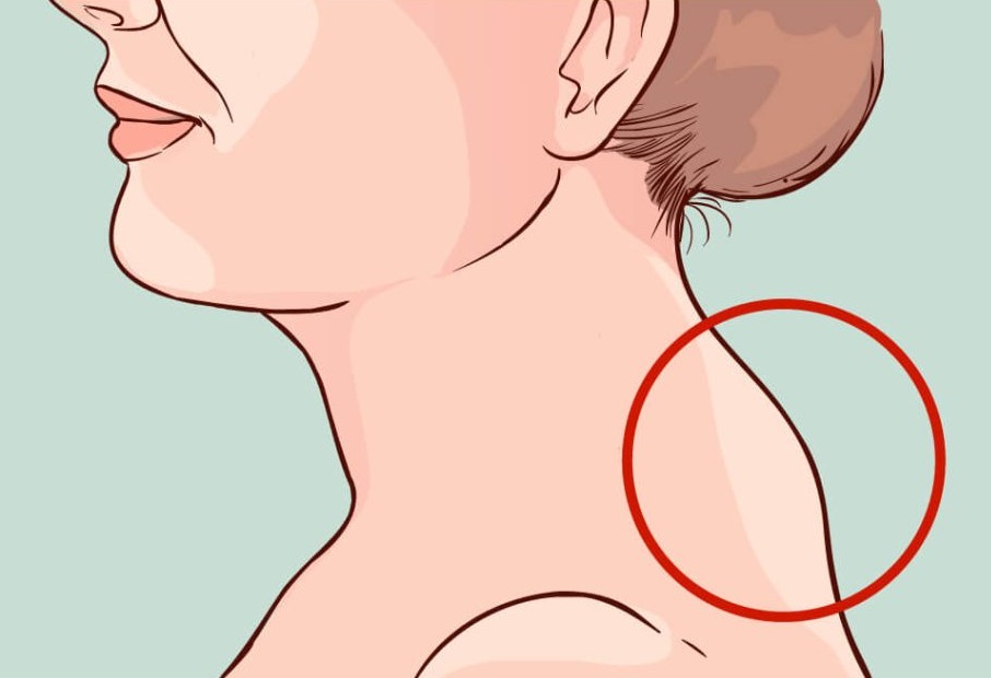 脂肪集中積聚在後頸時，因而出現」富貴包」。網上圖片