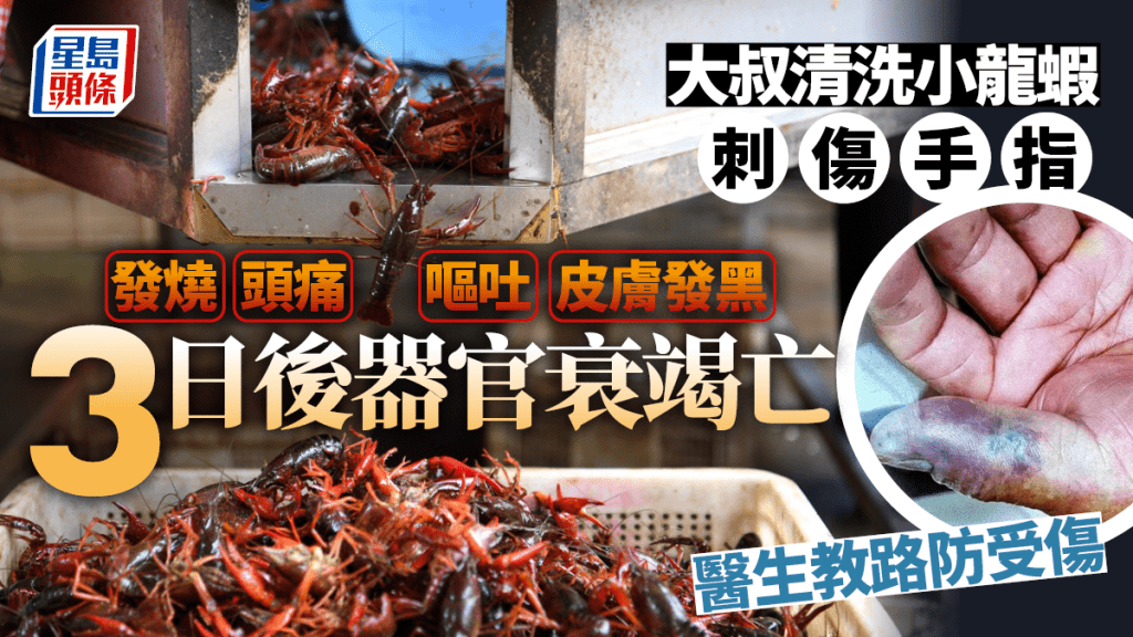杭州大叔洗小龍蝦手指被刺傷,被維隆氣單胞菌攻擊,3天後多臟器衰竭亡。