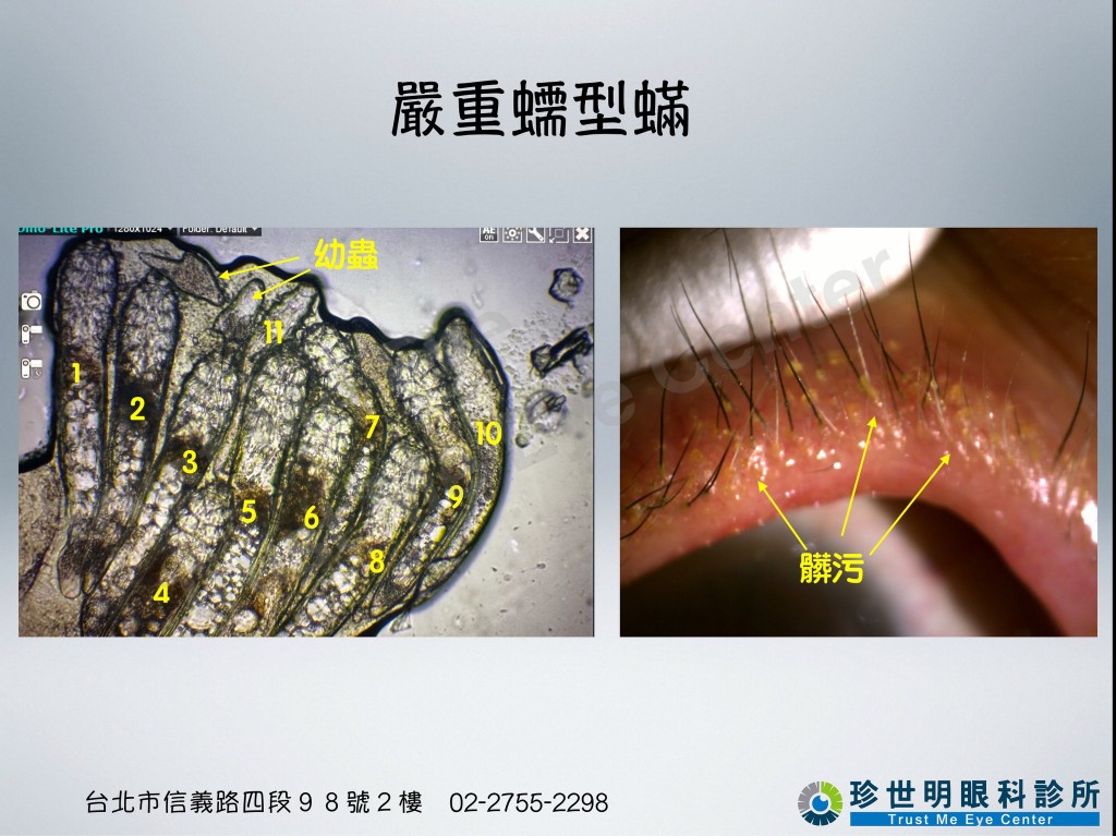 在显微镜下可现，该女子一条睫毛竟藏有11条蠕形蟎虫。（图片获「王孟祺医师-眼科最前线」授权转载）