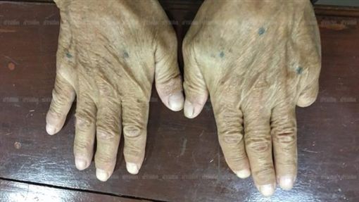 白井繁治的斷指。網圖