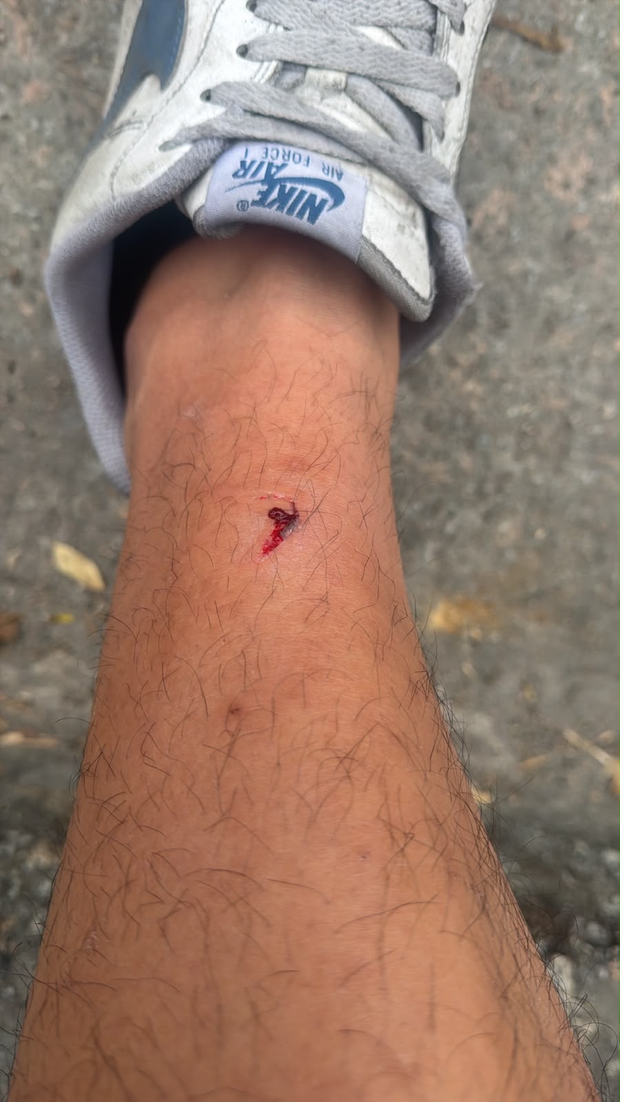 男事主小腿傷勢。 男事主小腿傷勢。