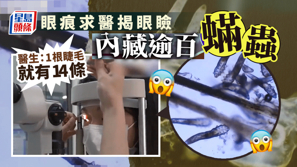 女子因眼睛痕癢前往求醫，發現眼瞼內至少有約100隻蟎蟲在爬行。
