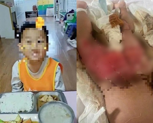 3歲男童意外跌進湯桶22％燙傷。