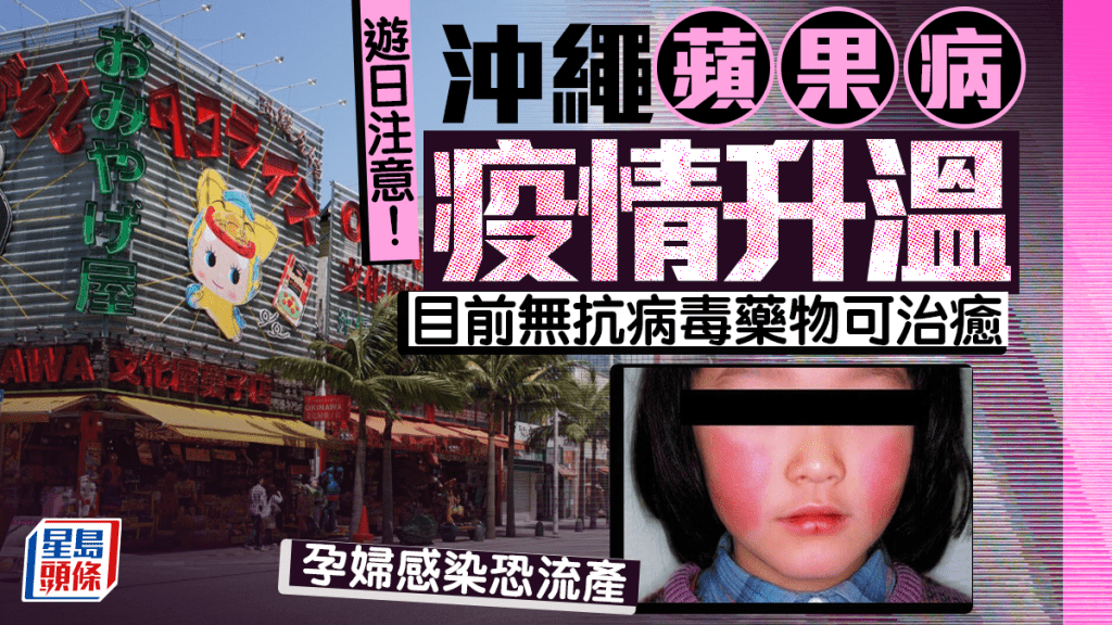 遊日注意 | 沖繩蘋果病疫情響警報 孕婦感染恐流產