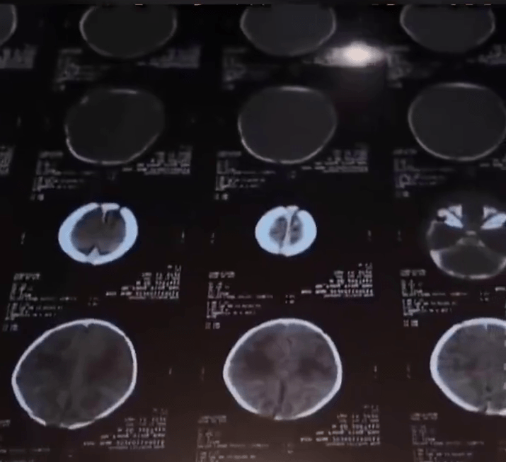 深圳6日大男嬰遭月嫂摔傷顱內出血入ICU搶救。
