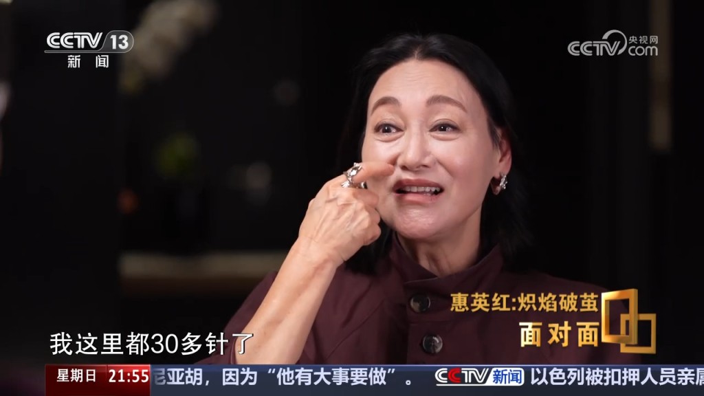 惠英紅曾在內地訪問中，表示臉上曾縫89針。
