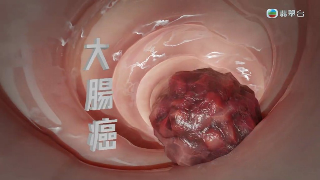 TVB节目《早D知早D医》昨晚（23日）主题为大肠癌。