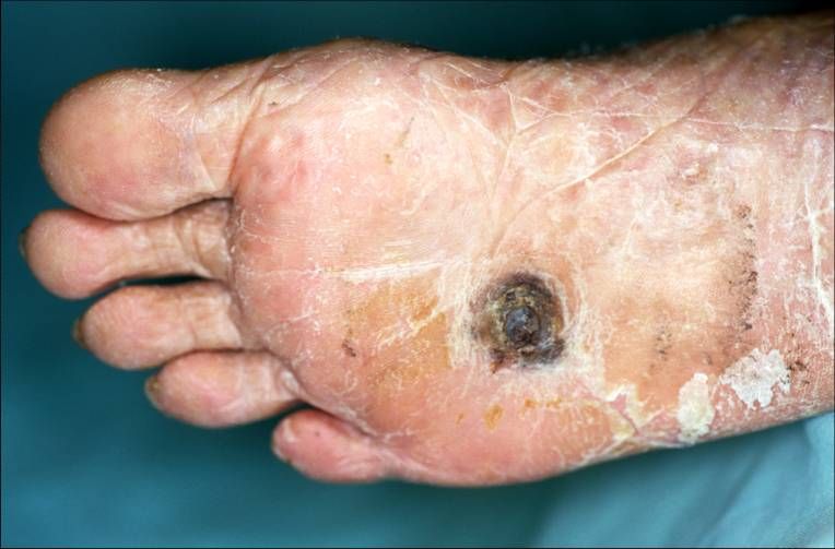 黑色素瘤有可能长在身体任何部位，例如脚掌上。