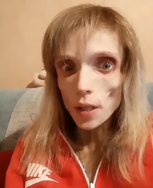 卡里亞金娜最瘦時只有38磅。(網圖)