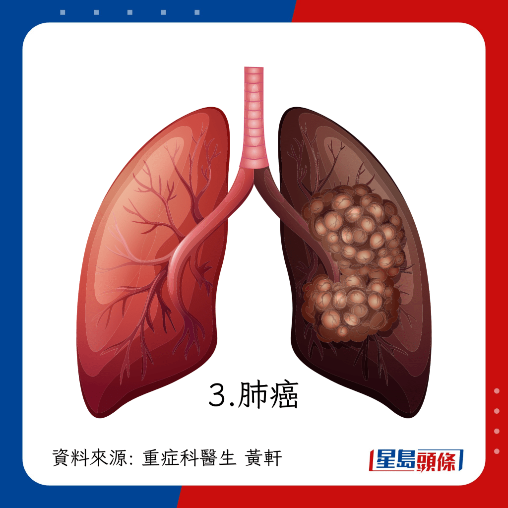 持续咳嗽可能患上肺癌