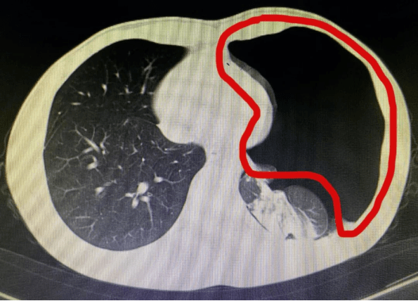 小陈左肺被压缩近9成。（红圈为气体）
