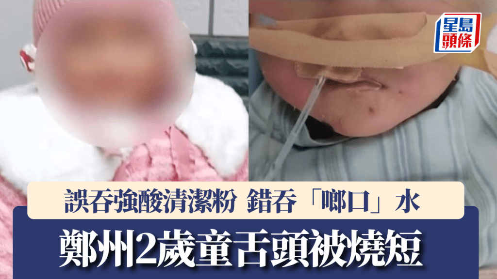 鄭州2歲女童誤吞強酸清潔粉，導致口腔嚴重灼傷，舌頭被燒短。錢江晚報