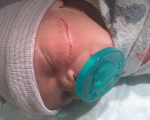剖腹生產的女嬰臉上出現長長刀痕。FB圖