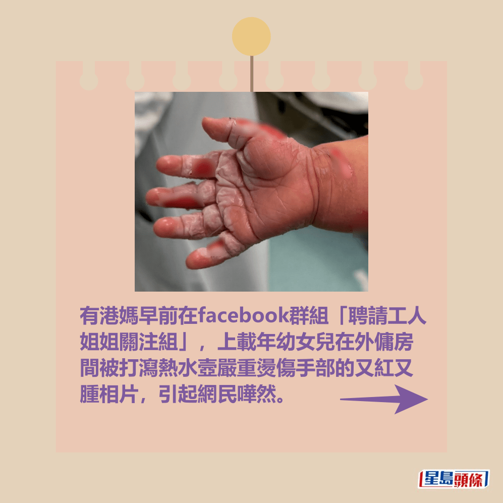 有港媽早前在facebook群組「聘請工人 姐姐關注組」,上載年幼女兒在外傭房 間被打瀉熱水壼嚴重燙傷手部的又紅又 腫相片,引起網民嘩然。fb「聘請工人姐姐關注組」截圖 有港媽早前在facebook群組「聘請工人 姐姐關注組」,上載年幼女兒在外傭房 間被打瀉熱水壼嚴重燙傷手部的又紅又 腫相片,引起網民嘩然。fb「聘請工人姐姐關注組」截圖