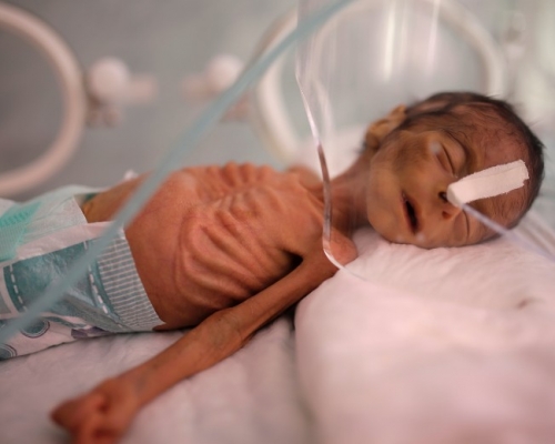 可怜的小生命，一出生便瘦骨嶙峋。 AP图