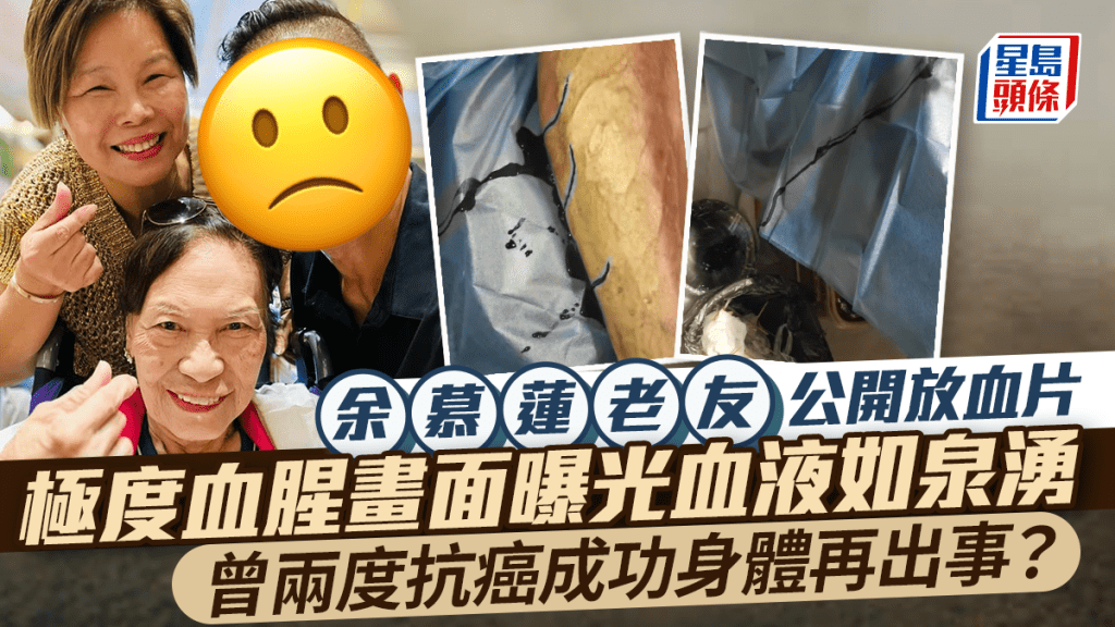 余慕蓮老友IG驚現放血片！極度血腥畫面曝光血液如泉湧  曾兩度抗癌成功身體再出事？