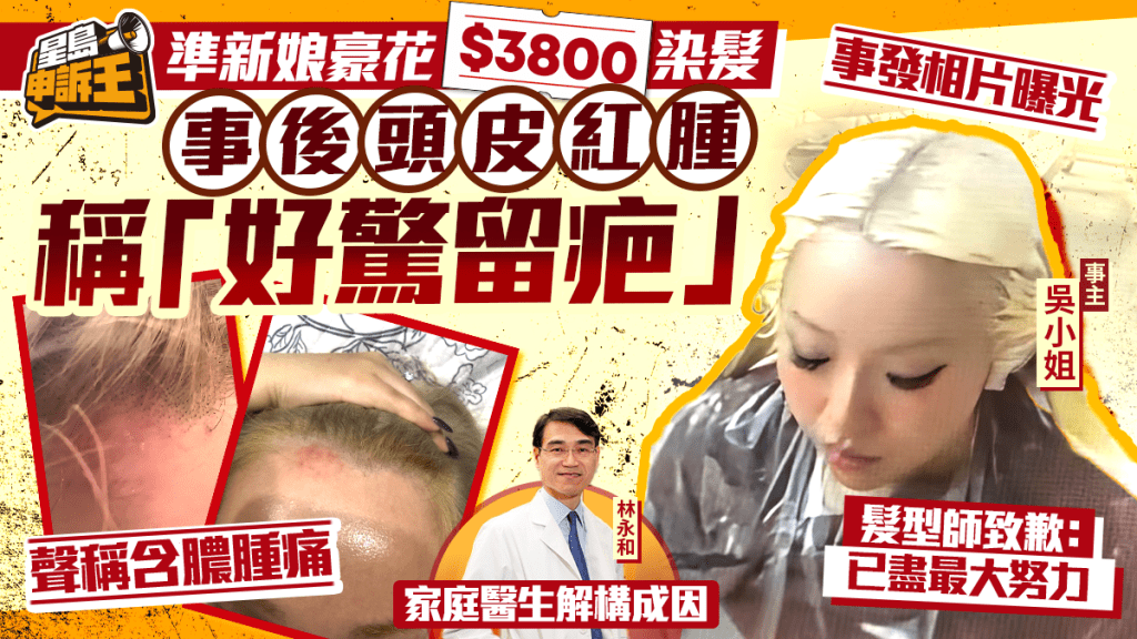 星島申訴王 | 準新娘豪花$3800染髮  事後頭皮紅腫痛楚驚留疤 髮型師致歉：已盡最大努力